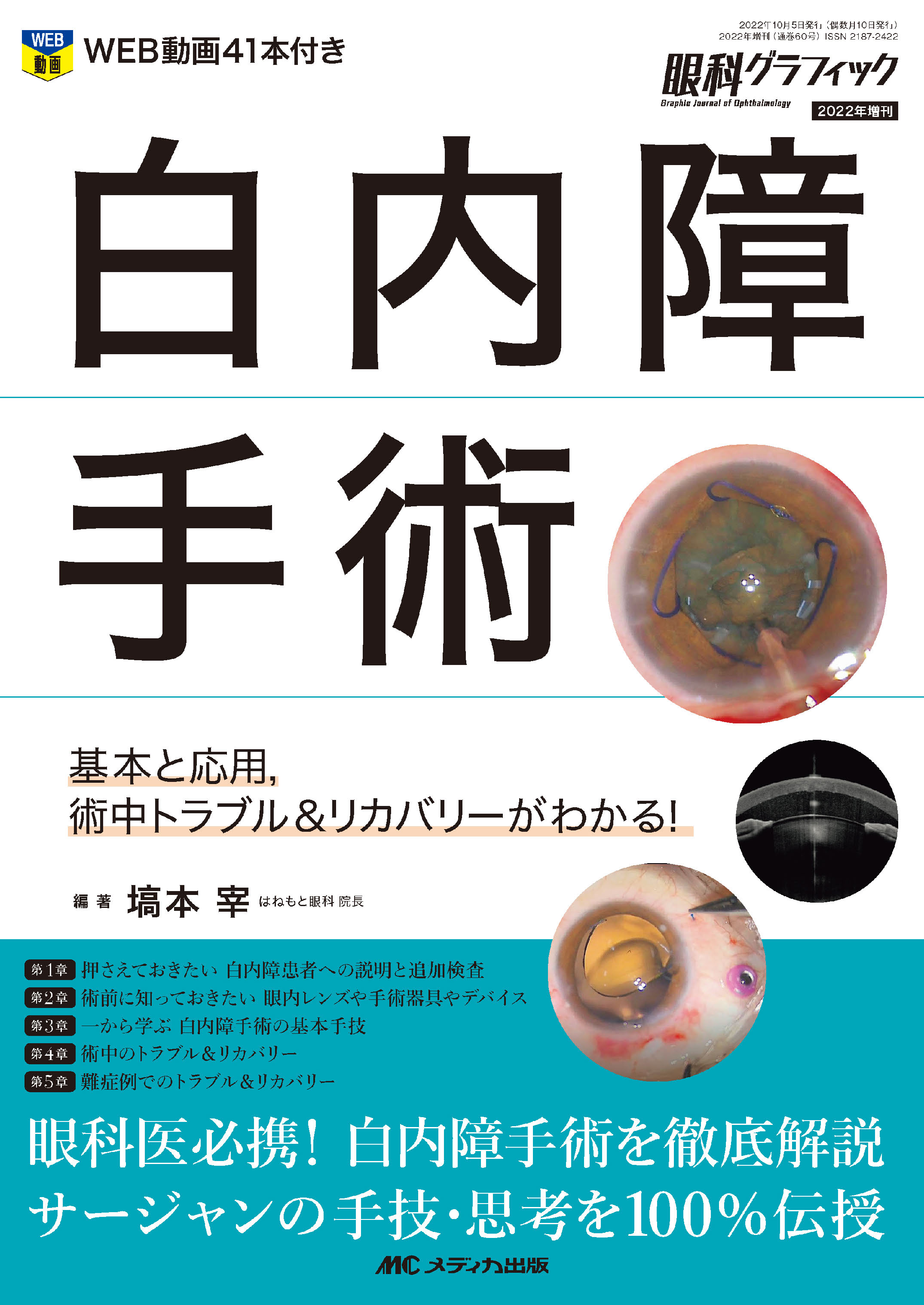 白内障手術 | 神陵文庫