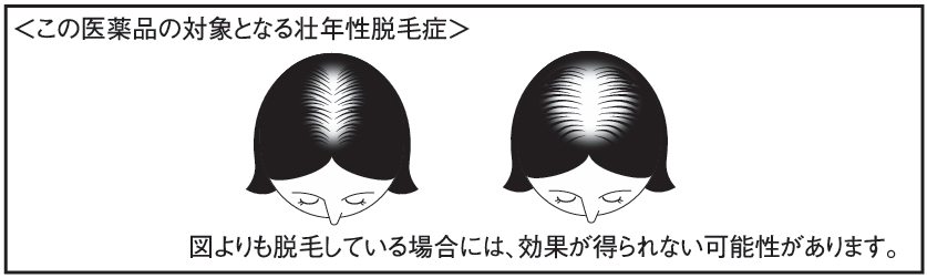 この医薬品の対象となる壮年性脱毛症
