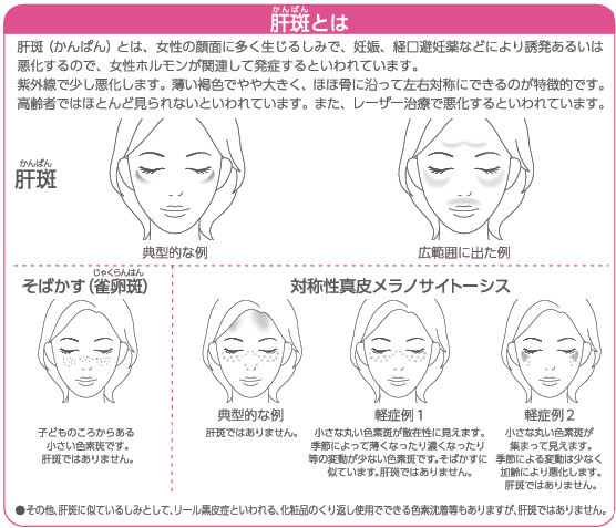 肝斑とは