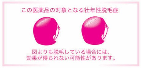 この医薬品の対象となる壮年性脱毛症